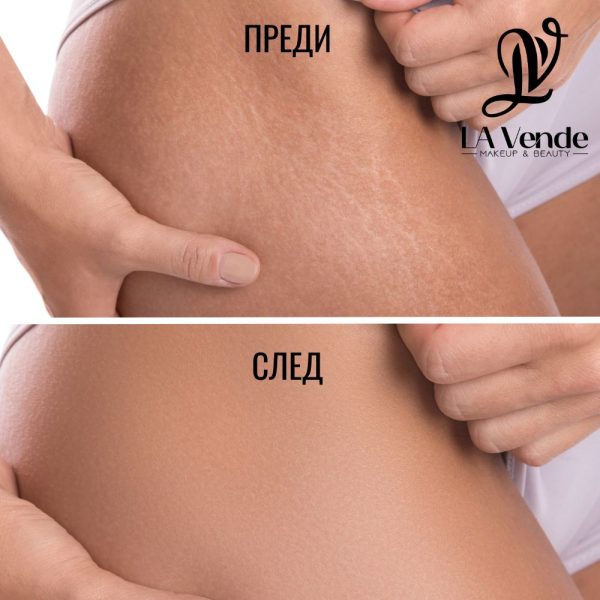 Анти стрии с какао и карите - Image 2