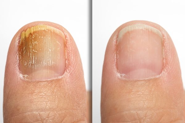 before and after successful treatment for a fungal infection on toe