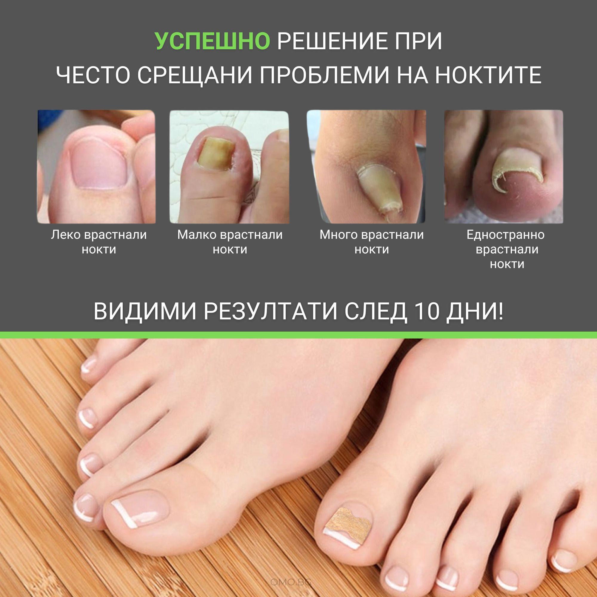 omo bg plastiri protiv vrastnali nokti 01