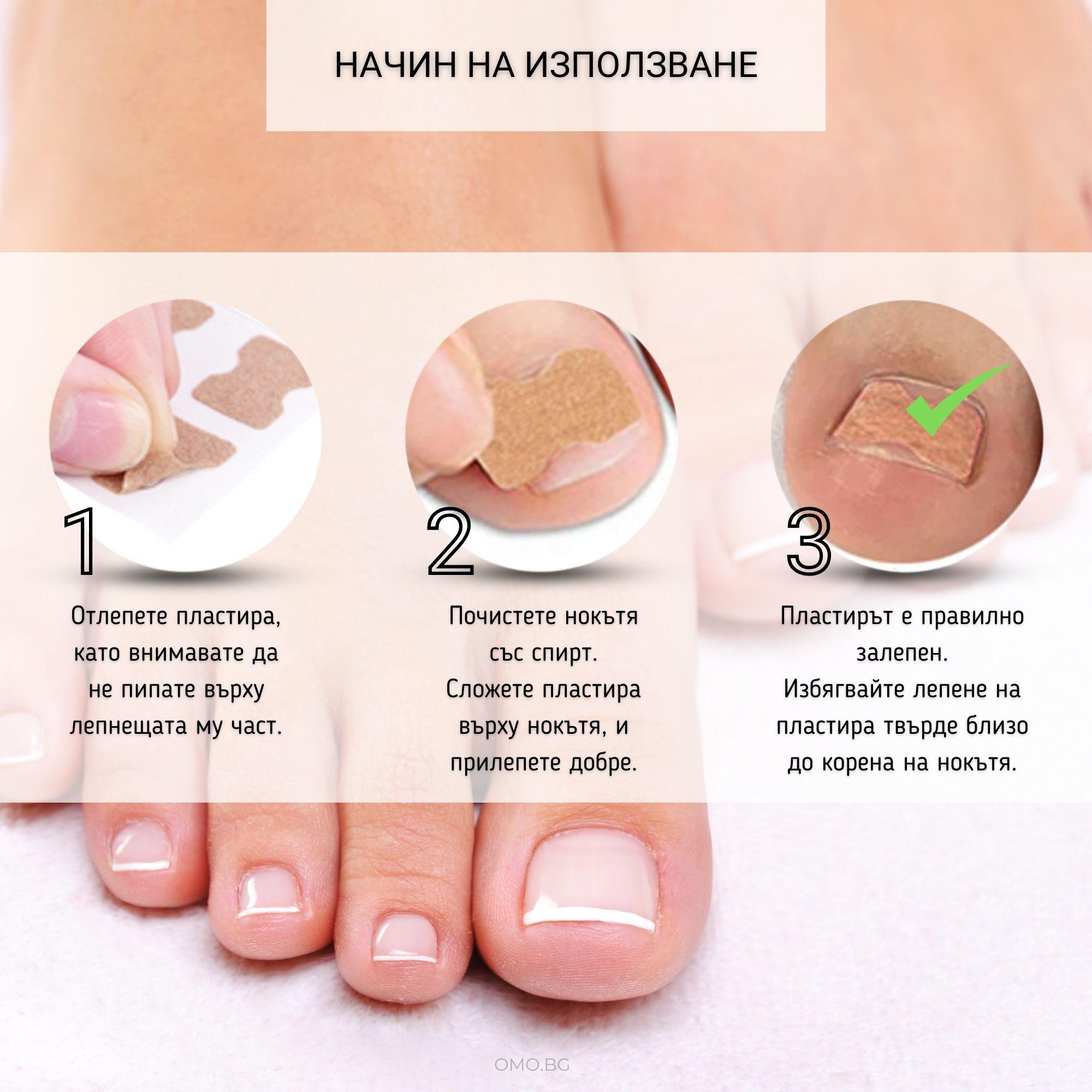 omo bg plastiri protiv vrastnali nokti 02