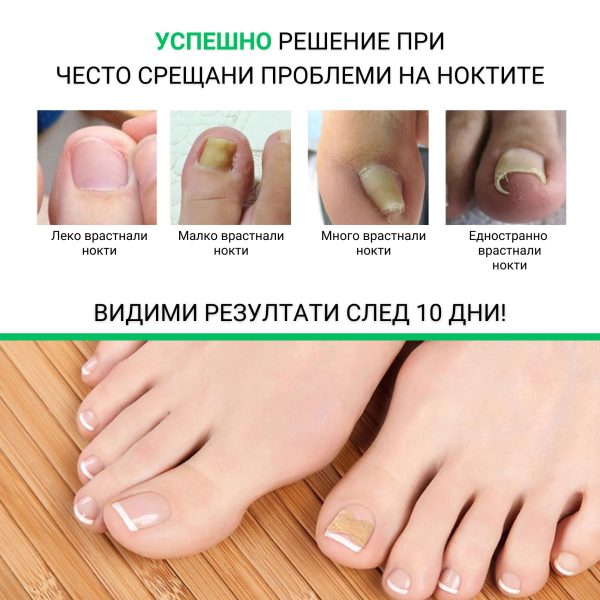 omo bg plastiri protiv vrastnali nokti 04