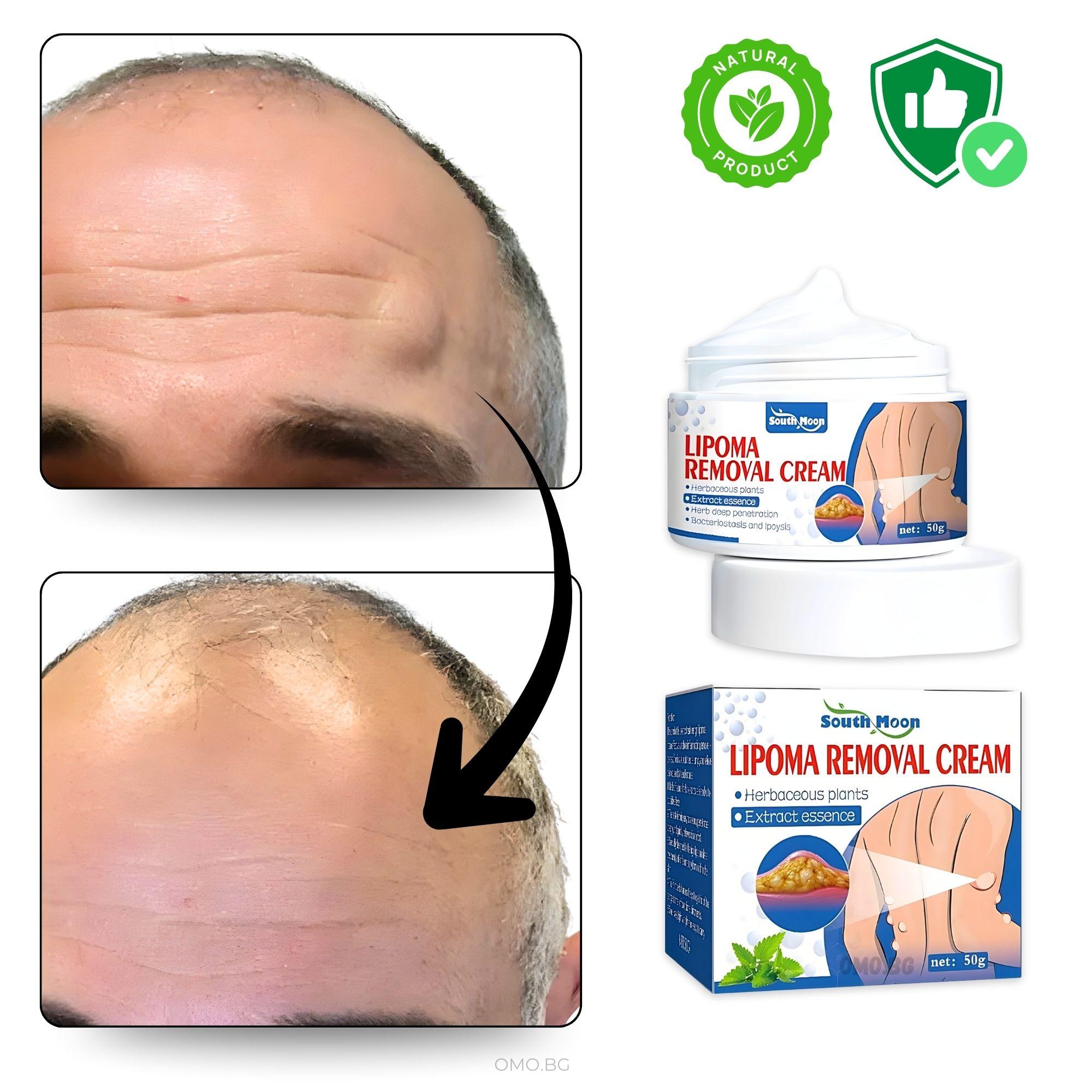 omo bg krem za lechenie na lipomi lipocream koncentriran 04