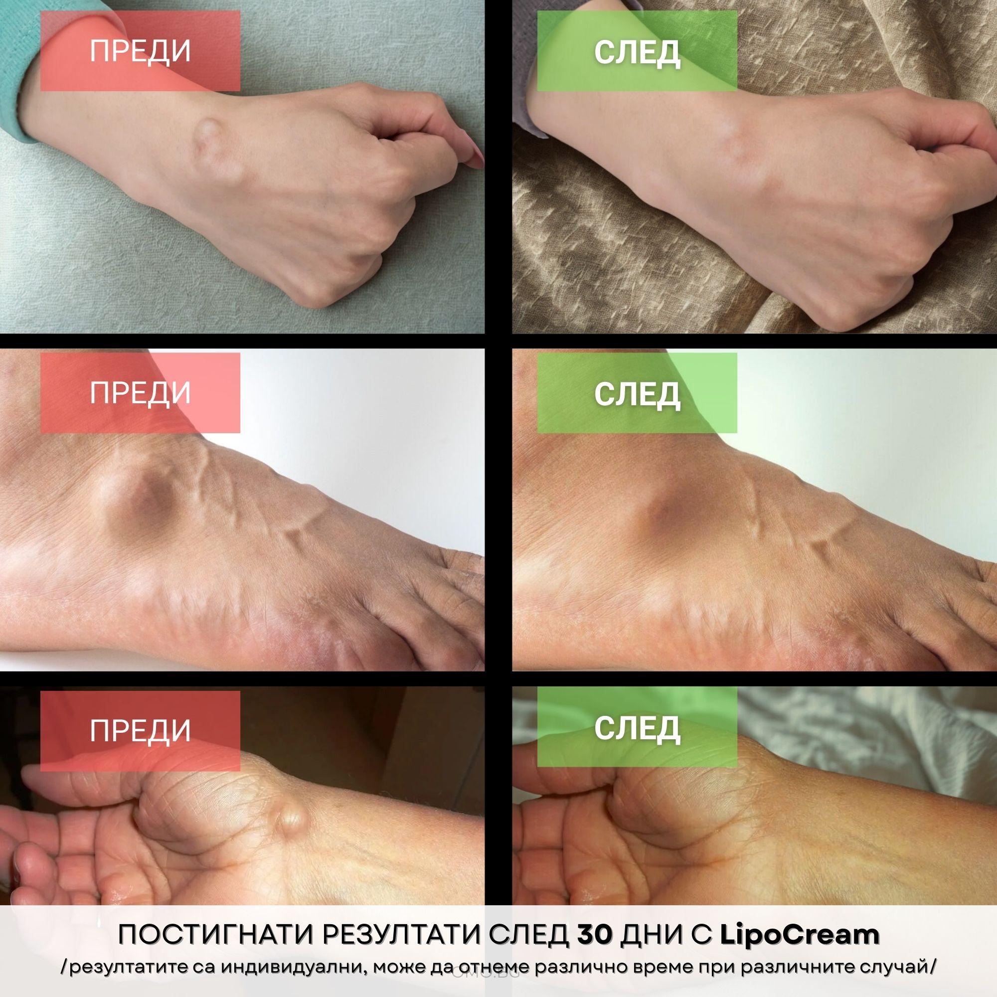 omo bg krem za lechenie na lipomi lipocream koncentriran 05